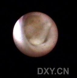 乳管镜视频,乳腺健康检查新视角